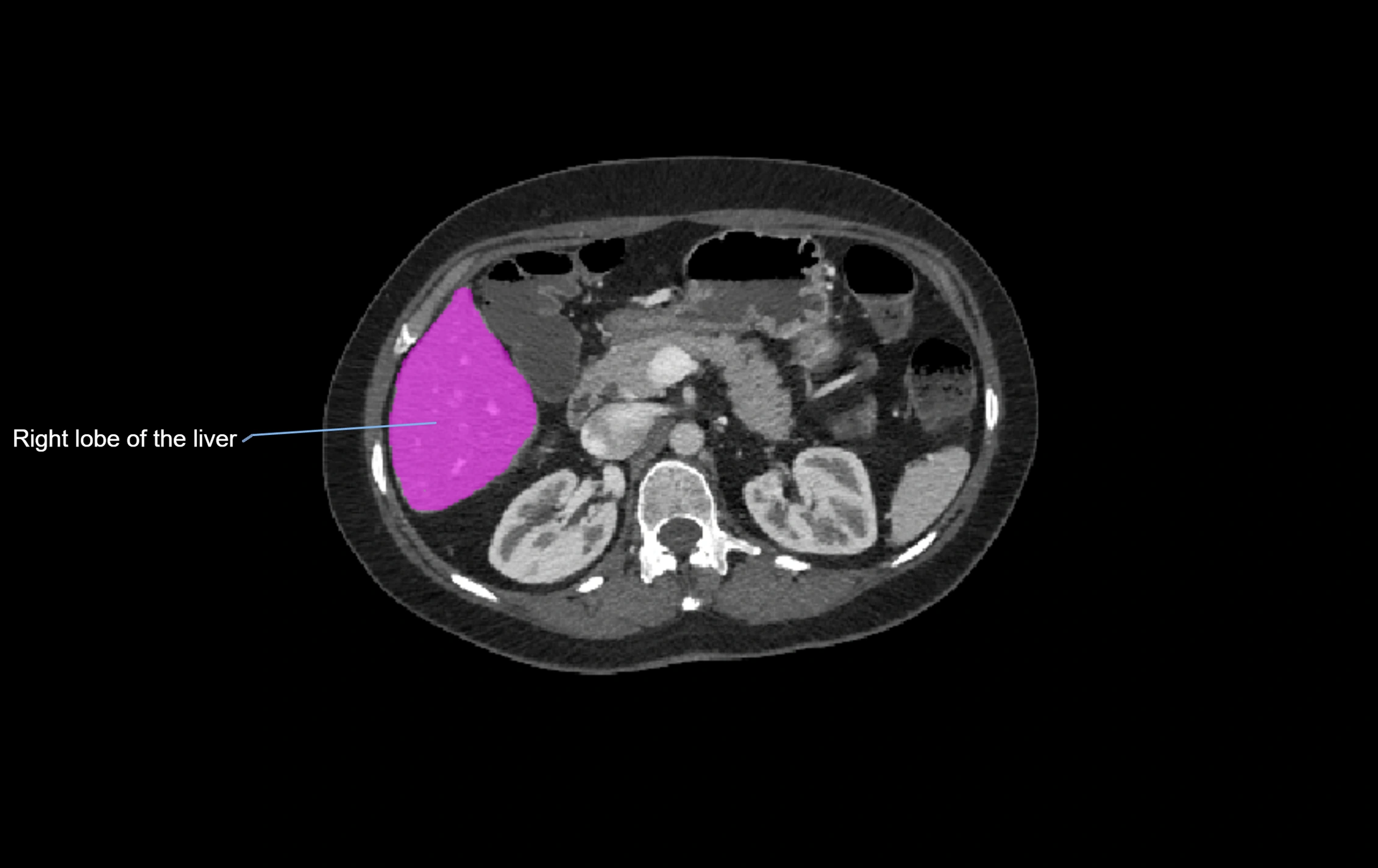 CT lliver lobes axial cross sectional anatomy labelled image -00032.webp